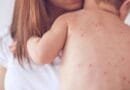Fruthi përhapet në Kosovë, 50 raste vetëm brenda një muaji