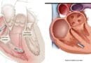 Pacemarkerët e rinj – Zemra po hyn në epokën pa kabllo