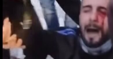 Brutaliteti i Policisë së Shqipërisë: Protestuesi goditet në sy me plumb gome